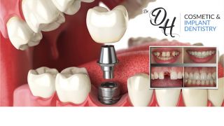cursos implantologia dental san pedro sula Cosmetic & Implant Dentistry - Dr. David Hernández